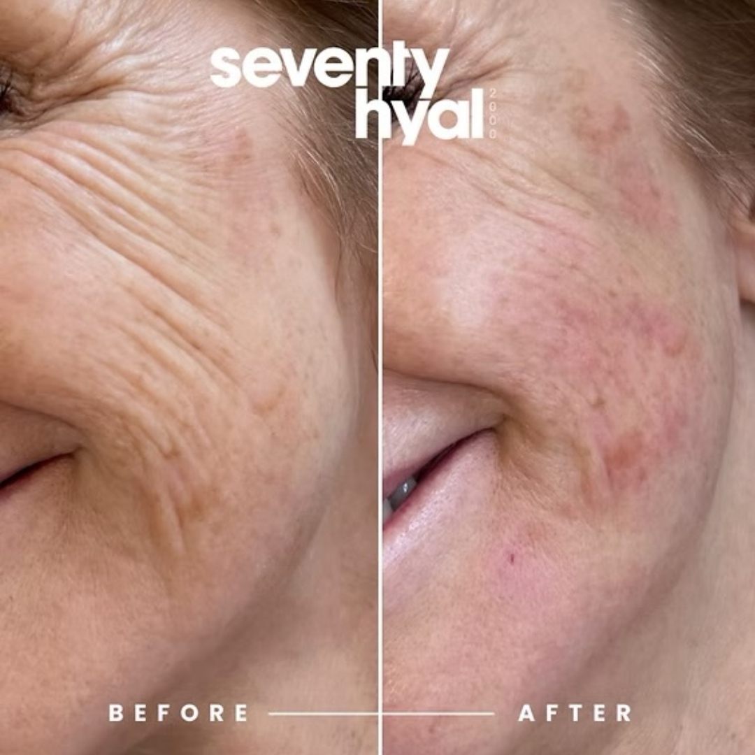 Seventy Hyal 70 – Skin Booster (Glow + Hydration Booster)