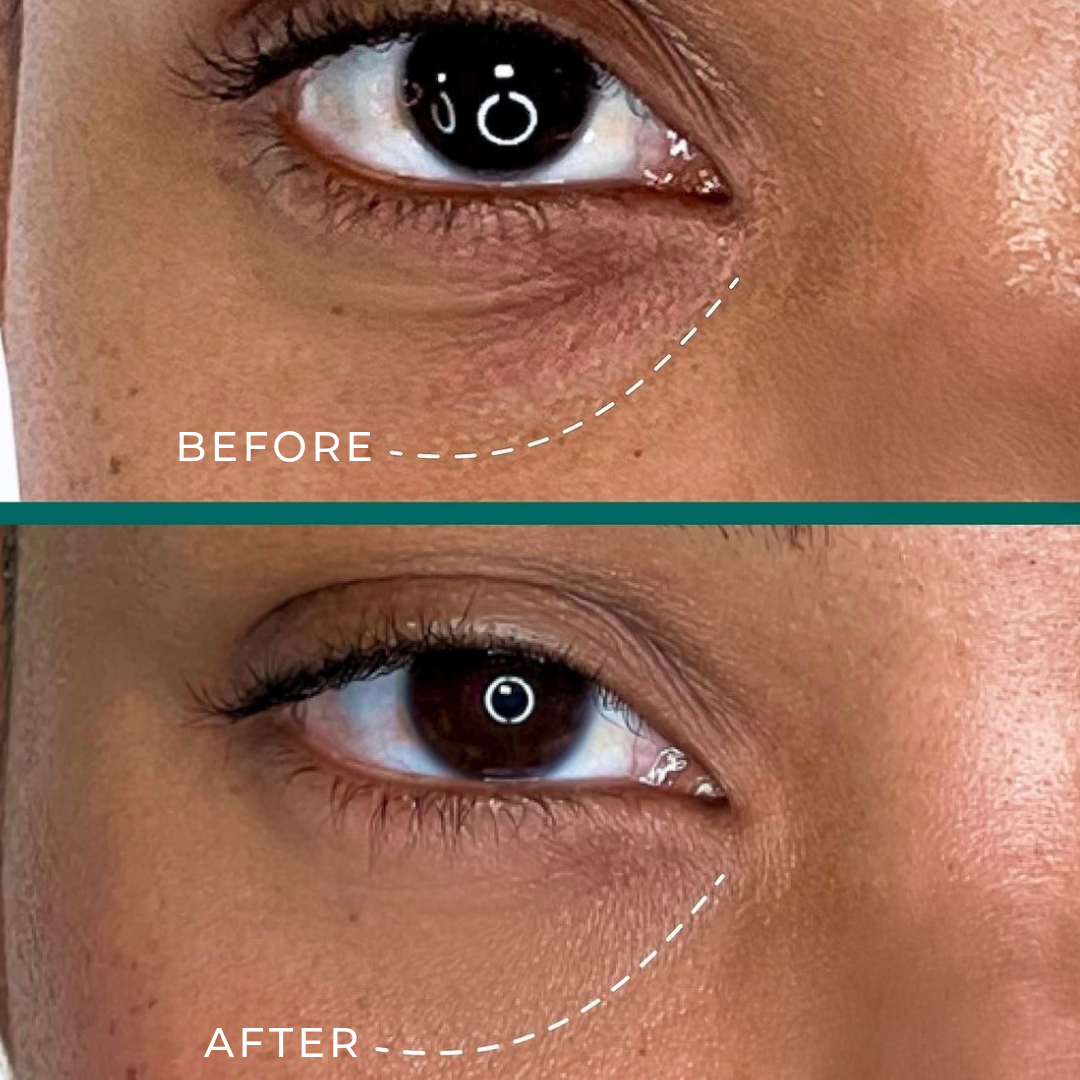 UNDER EYE SKIN BOOSTER