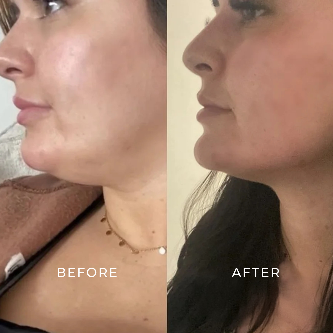 LEMON BOTTLE FAT DISSOLVING